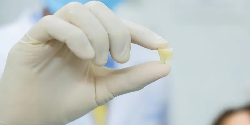 Lý giải ý nghĩa giấc mơ nhổ răng